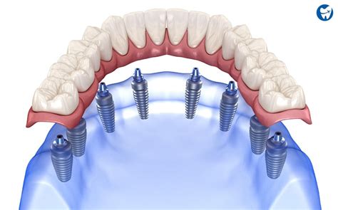 dental implants cost in cambodia|Dental Work in Cambodia .